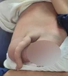 Phẫu thuật thành công cho bé trai 4 tháng tuổi có "đuôi" dài 14cm