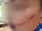 Nhìn 2 vết xước trên mặt học sinh Hà Nội này mà xót: Câu chuyện phía sau thổi bùng tranh luận