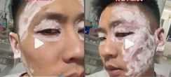 Mặt sưng vù sau khi lau bằng khăn giấy ở nhà hàng