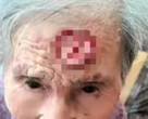 Cụ bà 98 tuổi dùng kéo cắt 'sừng trường thọ' trên trán, dẫn đến nguy kịch