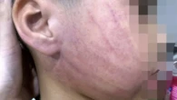 Điều tra vụ bé 4 tuổi nghi bị giáo viên mầm non đánh bầm tím mặt