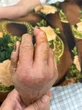 Ra chuồng gà vào buổi tối, người phụ nữ ở Phú Thọ phải đi cấp cứu với bàn tay sưng húp, đau nhức dữ dội