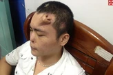 Không phải ảnh lỗi của AI, người đàn ông này đã thực sự mọc một chiếc mũi trên trán: Đó là "tác phẩm" của các bác sĩ Trung Quốc
