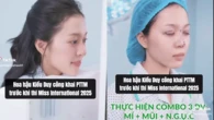 Thêm Hoa hậu 2k3 nhà Sen Vàng công khai “dao kéo” trước thềm thi Quốc tế