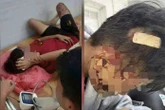 Mâu thuẫn cá nhân, học sinh lớp 8 bị bạn dùng gậy đánh nhập viện