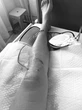Siêu mẫu Minh Tú sốc vì bị đứt dây chằng chéo trước, rách sụn, dập xương