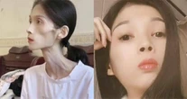 Số phận bi thảm của cô gái xinh đẹp biến thành 'bộ xương di động' 17kg