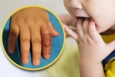 Mẹ dùng băng quấn để ngăn con mút tay, em bé suýt phải cắt cụt ngón