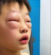 Chuyện thật như đùa: Cậu bé tiểu học "dị ứng" với bài tập về nhà, cứ mở vở ra là mắt sưng như mắt ếch!