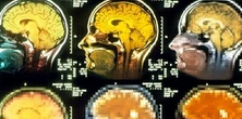 Masz te objawy? Naukowcy: mogą znacznie zwiększyć ryzyko wystąpienia choroby Alzheimera
