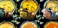 Naukowcy testują pigułkę przeciwko chorobie Alzheimera. Co mówią eksperci?