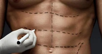 Abdominoplastia em homens exige cuidados no pós-operatório