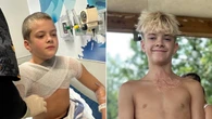 Microwaved squishy toy explodes onto boy's face and chest amid viral trend, causing horrific burns