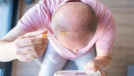 Experimental serum shows promise in reversing baldness within 20 days