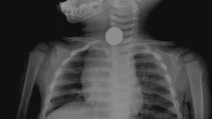 These are some of the strange objects that get stuck in people's bodies, according to CDC data