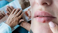 Cold sores may play role in Alzheimer's development, new research reveals