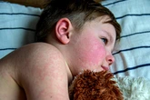 Parvovirus or ‘slapped cheek disease’ is on the rise, CDC warns: Here’s what to know