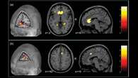 Rischio alto di deficit visuocostruttivi per i pazienti con Covid lieve: cosa sono e cosa comportano