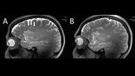 Anomalie mai viste rilevate nel cervello dei pazienti con emicrania: possibili risvolti per una cura