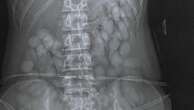 X-ray reveals 'cocaine bullets' in woman's stomach