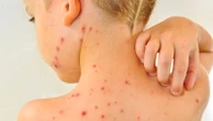 Chickenpox vaccine to be offered on NHS next year