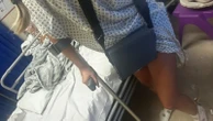 Woman told she may have to lose leg to stay alive after liquid Brazilian butt lift