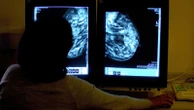 'Transformational' new drug could stop breast cancer tumours before they grow, trial finds