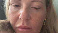 'It's the Wild West': Dozens of women develop botulism linked to anti-wrinkle injections