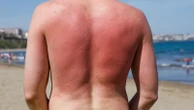 Sunburn isn't just red skin - here's what's happening underneath the burn