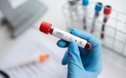 рф зберігає найвищу частку ВІЛ-позитивного населення в Європі - розвідка