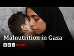 Warnings of malnutrition in Gaza as Donald Trump says Hamas won’t agree ceasefire | BBC News