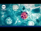 Cyclosporiasis cases surge after RFK Jr. said  outbreak was contained