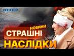 КІЛЬКІСТЬ ПОРАНЕНИХ зросла до 94  СУМИ оговтуються від ворожого РАКЕТНОГО УДАРУ 24.03.2025