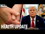 Donald Trump diagnosed with vein condition amid public speculation