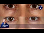 Cómo corregir las ojeras con resultados duraderos | Corpore Sano