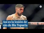 Así son las lesiones sufridas por Ilia Topuria en sus ojos que pueden causar visión doble