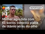 Mulher agredida com 61 socos colocou placa de titânio atrás do olho em reconstrução da face