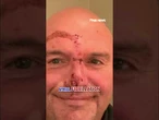 OUCH!: Fetterman reveals bloody face after fall sends him to hospital #shorts #usa #politics