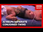 Conjoined twins separated with the help of AI | BBC News