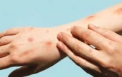En México, Mpox registra un aumento del 860% de casos en 2025