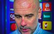 Guardiola se vuelve viral por heridas en el rostro tras empate en Champions: 'Me quería hacer daño'