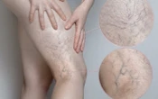 Chân đau nhức, mạch máu lộ rõ cảnh báo bệnh lý đang đe dọa 1/3 người trưởng thành