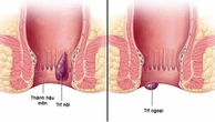 5 thủ phạm ‘giấu mặt’ gây ra nỗi ám ảnh mang tên bệnh trĩ