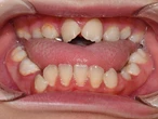 Hội chứng dính sớm các đường khớp sọ: Bệnh di truyền có thể nhận biết sớm nhờ khám răng hàm mặt