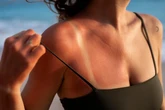 Đừng tin lời đồn ánh nắng mặt trời không gây ung thư da