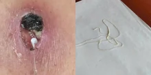 Phát hiện một ca mắc giun rồng, loại ký sinh trùng hiếm gặp dài hàng mét