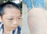 Công an xác minh vụ bé trai nghi bị đánh bầm tím