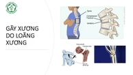 Loãng xương - căn bệnh bị xem nhẹ nhưng tỉ lệ tử vong cao
