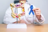 5 dấu hiệu ung thư đại tràng phổ biến thường bị bỏ qua
