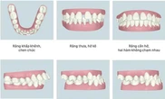 Hai lợi ích ít được biết đến của việc niềng răng